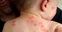 Đối phó với bệnh eczema mùa thu đông